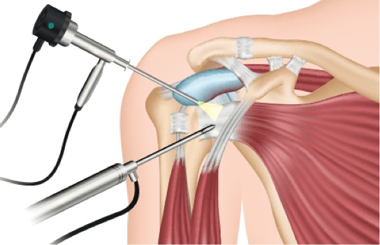 Shoulder Arthroscopy Surgery